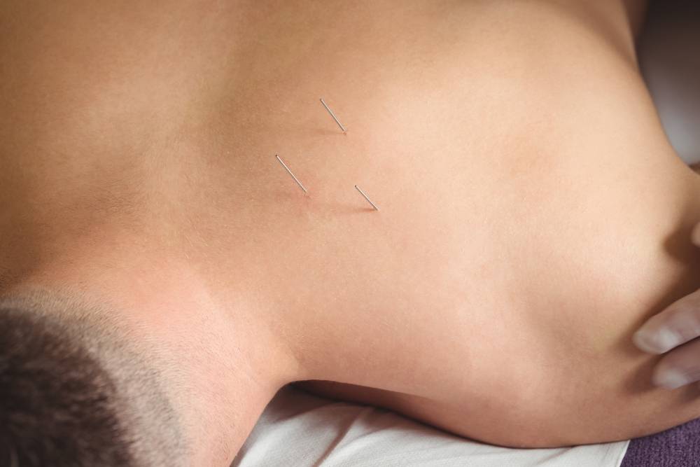 Why Asheville Chooses Us for Dry Needling